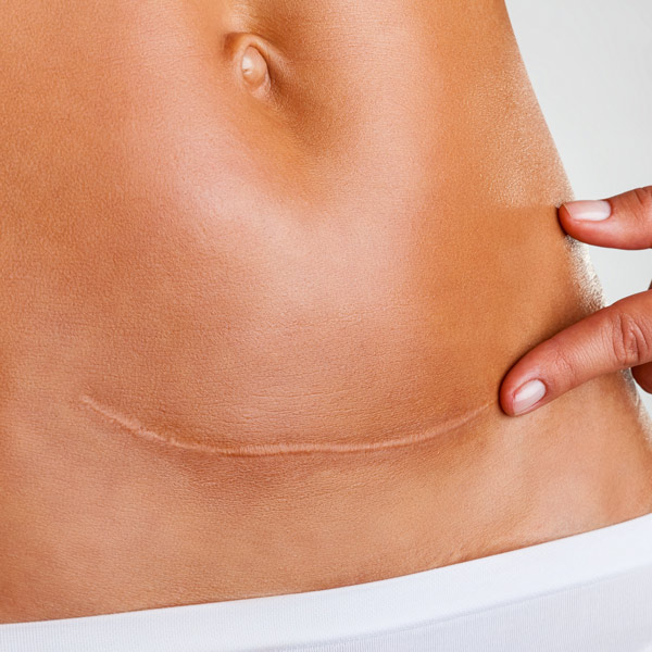 closeup of c-section scar
