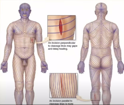 langers lines and wound incisions
