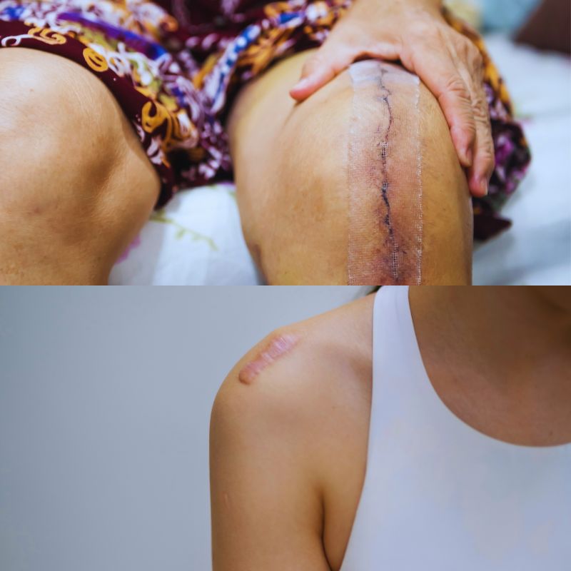 post joint surgery scar tissue therapy long island