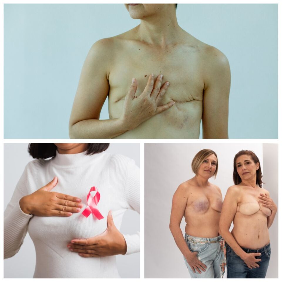 breast surgery scar therapy